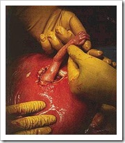 Aborto en la clínica