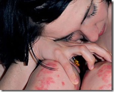 Aprendiendo a vivir con psoriasis…